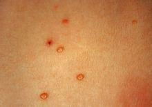 肉赘激光手术多少钱，肉赘与疣的区别图片