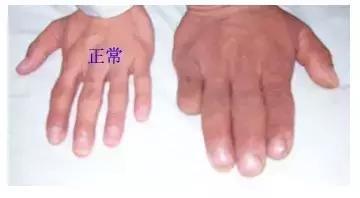 肢端肥大症治疗需要多长时间?