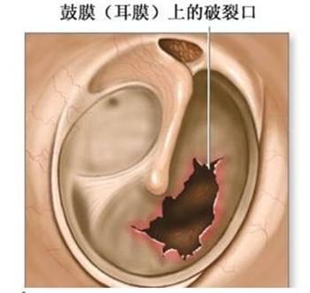 鼓膜穿孔会怎么样，鼓膜破了会聋掉吗