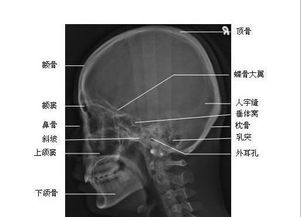 打扰一下,侧位片是ct还是x片?那个方位的?是不是从腹部看过去的?_百 