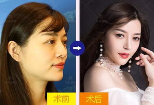 鼻尖发红是什么原因，鼻尖上长痘痘又红又肿碰到特别疼怎么办